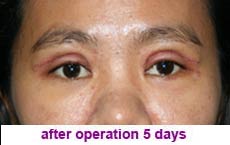 plastic-surgery-blepharoplasty